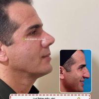 جشنواره جراحی و عمل بینی/لیفت/پلک|خدمات آرایشگری و زیبایی|کرج, درختی|دیوار