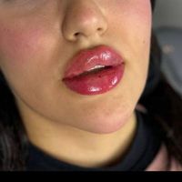 فیلر ژل لب چانه و بوتاکس پیشانی|خدمات آرایشگری و زیبایی|تهران, میرداماد|دیوار