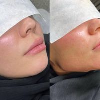 تزریق ژل لب زاویه فک چانه کونه وبوتاکس|خدمات آرایشگری و زیبایی|تهران, ائمه اطهار|دیوار