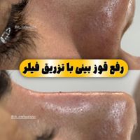 فیلربادی،تزریق فیلر و بوتاکس،هایفو صورت و غبغب|خدمات آرایشگری و زیبایی|تهران, سعادت‌آباد|دیوار