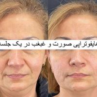 تخصص ما لیزر موهای زائد و ژل و بوتاکس حرفه ای و..|خدمات آرایشگری و زیبایی|تهران, شهرک ولیعصر|دیوار