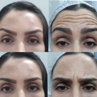 بوتاکس/ ژل گونه چانه فک/مزوژل/لیفت بینی ابرو/مزو|خدمات آرایشگری و زیبایی|تهران, فدک|دیوار