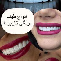 بیلچینگ کامپوزیت پالیش کاشت مصنوعی|خدمات آرایشگری و زیبایی|تهران, حکیمیه|دیوار