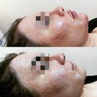 تخفیف بوتاکس،فیلر،هایفو،کربوکسی،مزوژل|خدمات آرایشگری و زیبایی|تهران, سازمان برنامه|دیوار
