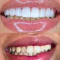 مدل کامپوزیت دندان|خدمات آرایشگری و زیبایی|تهران, هاشمی|دیوار