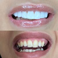 مدل کامپوزیت دندان|خدمات آرایشگری و زیبایی|تهران, هاشمی|دیوار