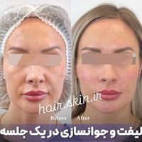 جشنواره50%تزریق ژل لب لیفت آنزیم 390بوتاکس لیزر|خدمات آرایشگری و زیبایی|تهران, شهرآرا|دیوار