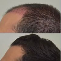 کاشت مو ابرو و ریش بدون درد با پایین|خدمات آرایشگری و زیبایی|تهران, جردن|دیوار