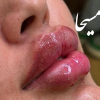 تزریق ژل لب گونه چونه زوایه بوتاکس مزو مو آنزیم|خدمات آرایشگری و زیبایی|تهران, امام سجاد(ع)|دیوار