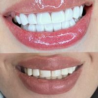 مدل کامپوزیت دندان|خدمات آرایشگری و زیبایی|تهران, هاشمی|دیوار
