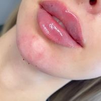لیزرمو بوتاکس ژل هایفو فیشیال رفع سیاهی زیرچشم|خدمات آرایشگری و زیبایی|تهران, هفت حوض|دیوار