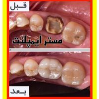 مستر ایمپلنت و ونیر کامپوزیت توسط پزشک|خدمات آرایشگری و زیبایی|تهران, تهران‌سر|دیوار