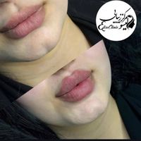 کلینیک تزریق ژل لب،بوتاکس،فیلر لیزر هایفوخال فشیال|خدمات آرایشگری و زیبایی|تهران, پیروزی|دیوار