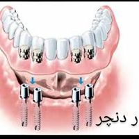 ساخت دندان مصنوعی هر فک فقط دو میلیون|خدمات آرایشگری و زیبایی|تهران, شمشیری|دیوار