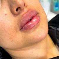 فیلر ژل لب چانه و بوتاکس پیشانی|خدمات آرایشگری و زیبایی|تهران, میرداماد|دیوار