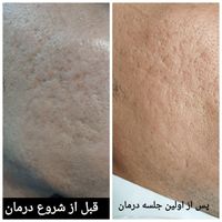 **درمان تخصصی و تضمینی اسکار آکنه**|خدمات آرایشگری و زیبایی|اصفهان, مولوی|دیوار