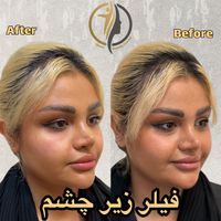 جشنواره ژل بوتاکس لیزر سعادت آباد|خدمات آرایشگری و زیبایی|تهران, سعادت‌آباد|دیوار