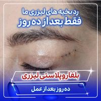 بلفاروپلاستی توسط جراح و متخصص چشم|خدمات آرایشگری و زیبایی|تهران, صادقیه|دیوار