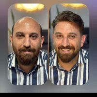 پروتز مو|خدمات آرایشگری و زیبایی|بانه, |دیوار