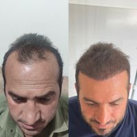 کاشت مو تبریز|خدمات آرایشگری و زیبایی|مرند, |دیوار