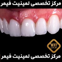 مرکز تخصصی لمینیت دندان ایمکس با شرایط|خدمات آرایشگری و زیبایی|تهران, جردن|دیوار