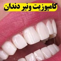 کامپوزیت دندان number 1 جشنواره|خدمات آرایشگری و زیبایی|تهران, هفت حوض|دیوار