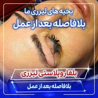 بلفاروپلاستی توسط جراح و متخصص چشم|خدمات آرایشگری و زیبایی|تهران, صادقیه|دیوار