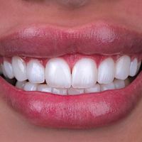 کامپوزیت دندان،لمینیت،روکش،عصب کشی|خدمات آرایشگری و زیبایی|تهران, سعادت‌آباد|دیوار