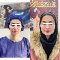 جشنواره تزریق چربی لیفت بانخ غبغب پلک ژل|خدمات آرایشگری و زیبایی|تهران, دانشگاه علم و صنعت|دیوار