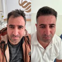 کاشت مو تبریز|خدمات آرایشگری و زیبایی|مرند, |دیوار