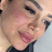 کلینیک تزریق ژل بوتاکس آنزیم فیلر لب لیزر هایفو|خدمات آرایشگری و زیبایی|کرج, گوهردشت|دیوار