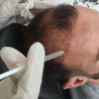 ‌ی پاییزه فیلر/بوتاکس/مزو/prp/ساکشن غبغب|خدمات آرایشگری و زیبایی|تهران, دروازه شمیران|دیوار