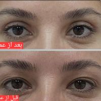 بلفارو پلاستی حرفه ای|خدمات آرایشگری و زیبایی|تهران, بلوار کشاورز|دیوار