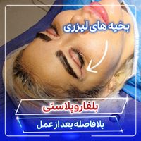 بلفاروپلاستی توسط جراح و متخصص چشم|خدمات آرایشگری و زیبایی|تهران, صادقیه|دیوار