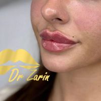 دکتر زرین لیپ ، فیلر لب روسی زاویه فک گونه چانه ژل|خدمات آرایشگری و زیبایی|تهران, پونک|دیوار