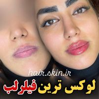 جشنواره50%تزریق ژل لب لیفت آنزیم 390بوتاکس لیزر|خدمات آرایشگری و زیبایی|تهران, شهرآرا|دیوار