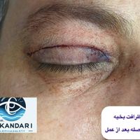 /بلفاروپلاستی/ساکشن غب غب/ اقساط/تخصصی توسط جراح|خدمات آرایشگری و زیبایی|مشهد, احمدآباد|دیوار