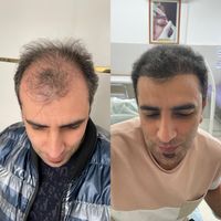 کاشت مو تبریز|خدمات آرایشگری و زیبایی|مرند, |دیوار