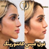 فیلر لب زاویه سازی صورت بوتاکس فیلر زیرچشم|خدمات آرایشگری و زیبایی|تهران, سعادت‌آباد|دیوار