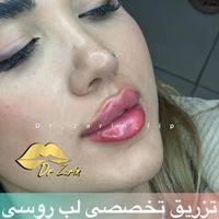 تزریق ژل بوتاکس جالپرو لیفت نخ مادلینگ فیلر|خدمات آرایشگری و زیبایی|تهران, پونک|دیوار