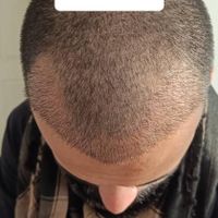 کاشت مو و ابرو به روش شیراز در اصفهان(اقساطی)|خدمات آرایشگری و زیبایی|اصفهان, مرداویج|دیوار