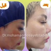 جشنواره ساکشن غبغب 4800 محدوده هروی|خدمات آرایشگری و زیبایی|تهران, هروی|دیوار