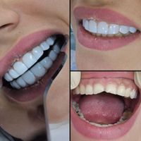 کامپوزیت دندان فقط 8500هر فک نقد و چک|خدمات آرایشگری و زیبایی|رشت, گلسار|دیوار