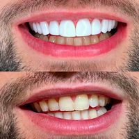 مدل کامپوزیت دندان|خدمات آرایشگری و زیبایی|تهران, هاشمی|دیوار