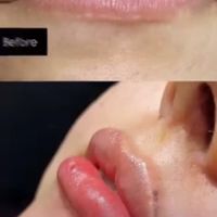 تخفیف بوتاکس،فیلر،هایفو،کربوکسی،مزوژل|خدمات آرایشگری و زیبایی|تهران, سازمان برنامه|دیوار