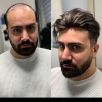 پروتز مو|خدمات آرایشگری و زیبایی|بانه, |دیوار