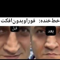 تزریق مدل توسط پزشک مدرس ژل بوتاکس لیزر نخ پی آرپی|خدمات آرایشگری و زیبایی|تهران, تهران‌سر|دیوار