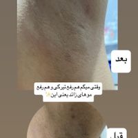 لیزر موهای زائد در نازی آباد ***********|خدمات آرایشگری و زیبایی|تهران, نازی‌آباد|دیوار