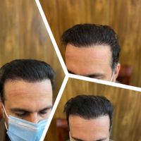کاشت مو با ضمانت فقط ۸ میلیون|خدمات آرایشگری و زیبایی|تهران, زعفرانیه|دیوار