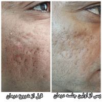 **درمان تخصصی و تضمینی اسکار آکنه**|خدمات آرایشگری و زیبایی|اصفهان, مولوی|دیوار